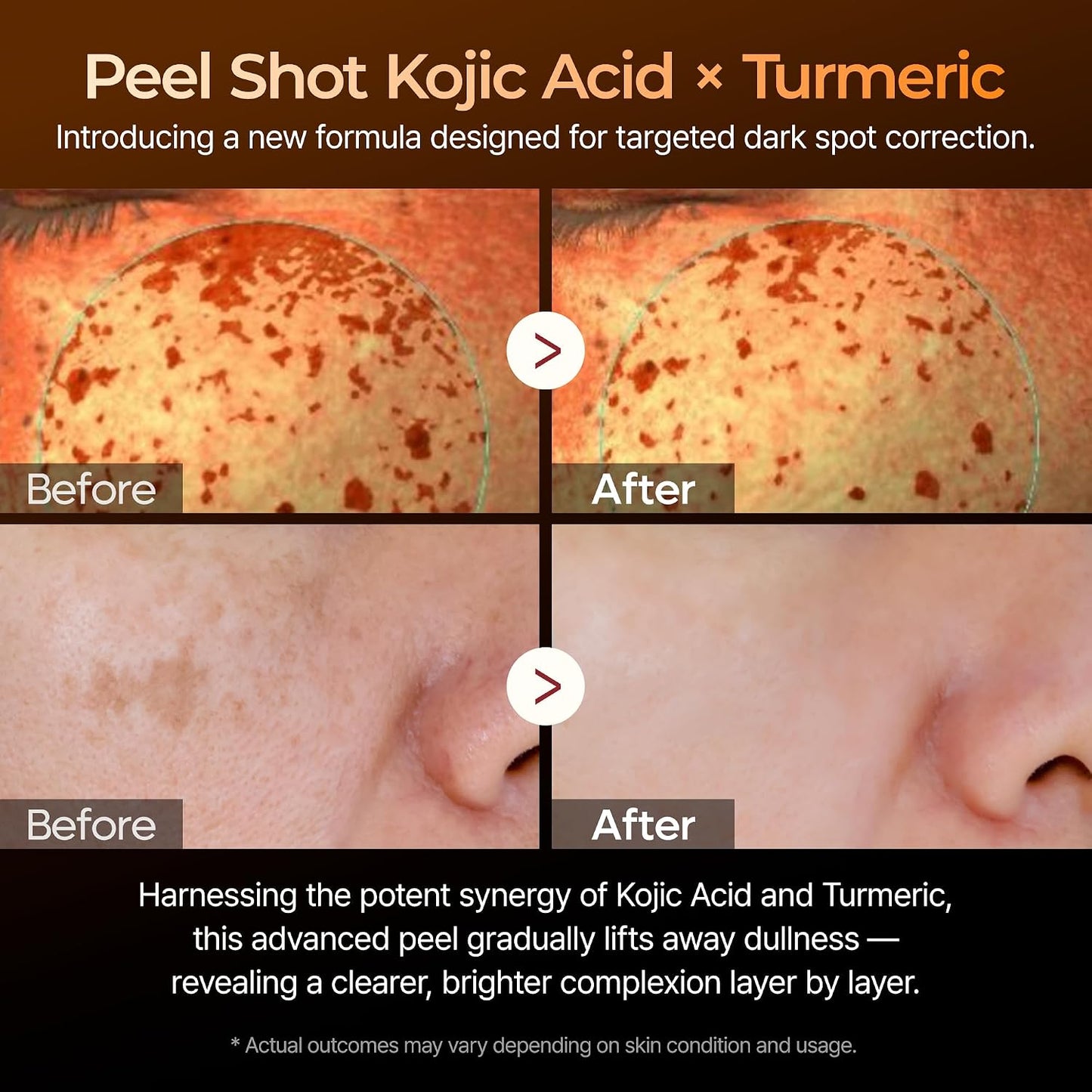 Kojic Acid Dark Spot Corrector Peeling Ampoule – AHA BHA Exfoliating Serum with Kojic Acid & Niacinamide for Dark Spots & Uneven Skin Tone, Korean Skincare 2.71 Fl.Oz