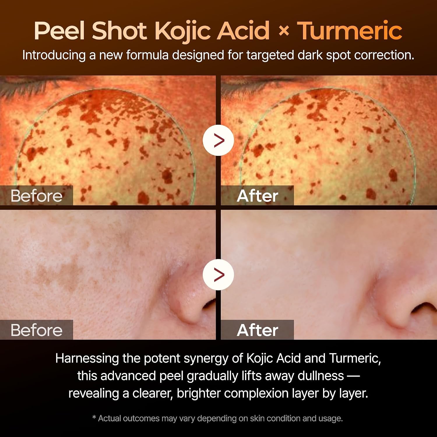Kojic Acid Dark Spot Corrector Peeling Ampoule – AHA BHA Exfoliating Serum with Kojic Acid & Niacinamide for Dark Spots & Uneven Skin Tone, Korean Skincare 2.71 Fl.Oz